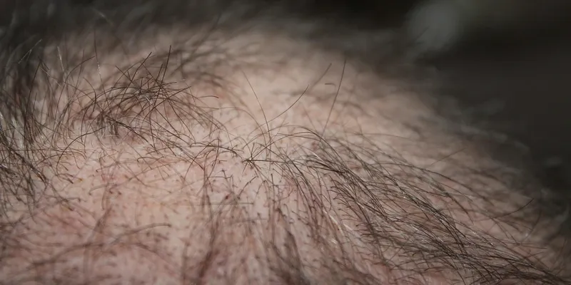 Hair Loss Site For Sell Template hair loss site for sell template