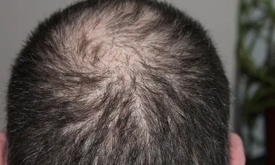 Predesigned Hair Loss Website for Sale