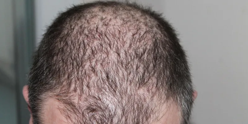 Hair Loss Summary hair loss summary