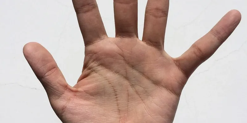 excessive sweating notes