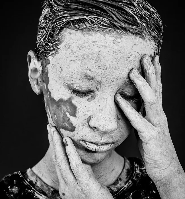 Instant Vitiligo Skin Remedy Website for Sale vitiligo skin remedy website for sale